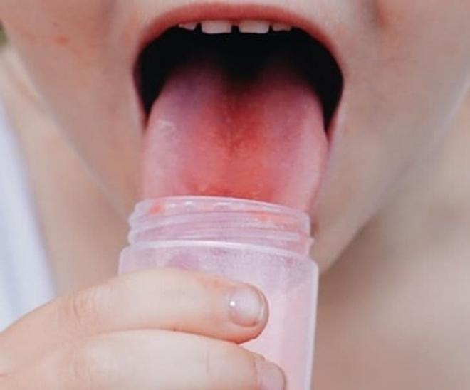 chữa lành vết bỏng rát lưỡi 6 chữa lành vết bỏng rát lưỡi 6