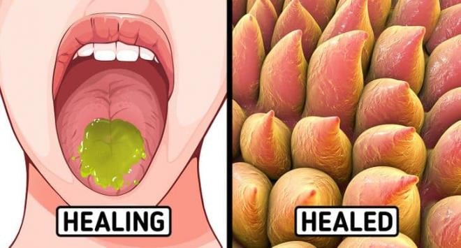 chữa lành vết bỏng rát lưỡi 7 chữa lành vết bỏng rát lưỡi 7