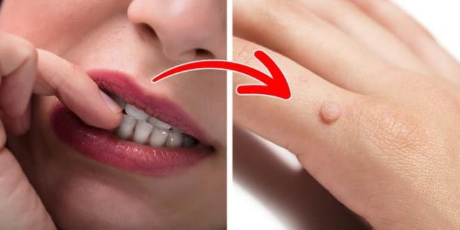 cách ngăn ngừa mụn cóc  4