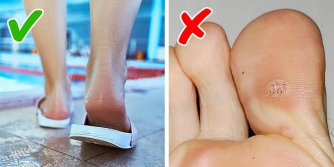 cách ngăn ngừa mụn cóc  0