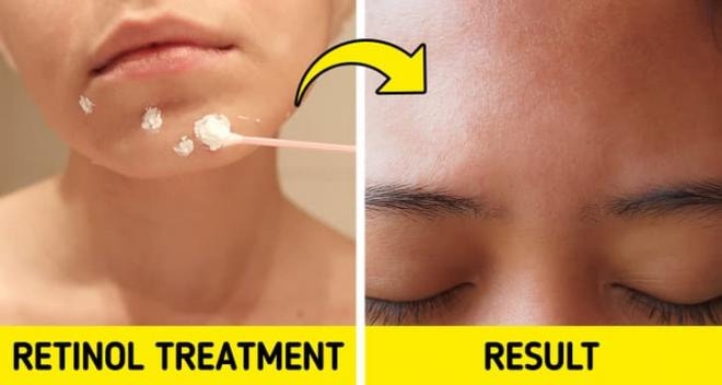 mụn nhỏ màu trắng trên da  2
