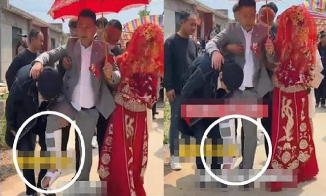 chú rể bị gãy chân 0