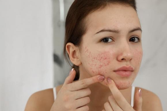 chăm sóc da, chăm sóc da mụn, làm đẹp 