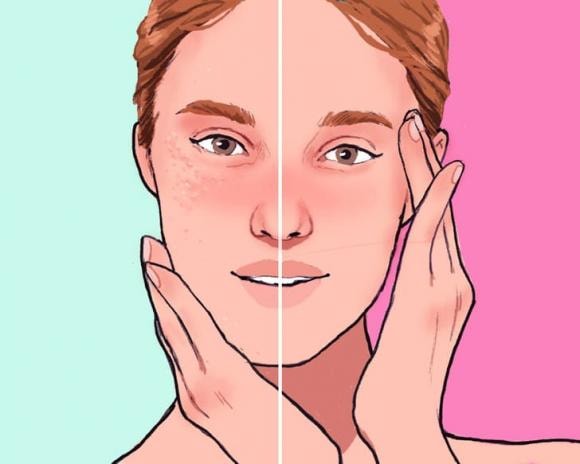 mụn trắng, mụn trắng ở gần mắt, sức khỏe 