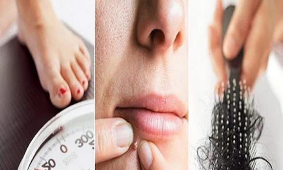 PCOS, buồng trứng đa nang, sức khoẻ phụ nữ
