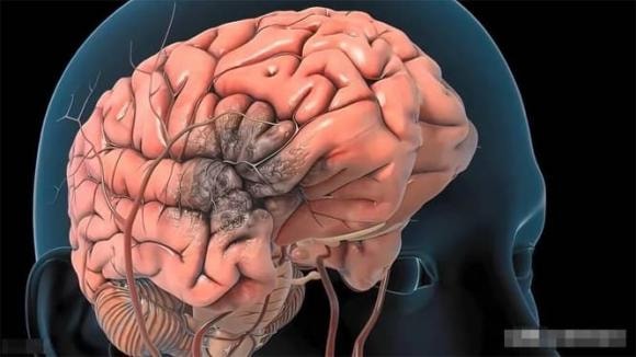 xuất hiện xuất huyết não, xuất huyết não