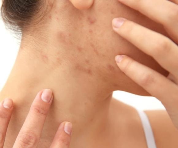 mụn mọc, mọc mụn, tại sao mọc mụn 