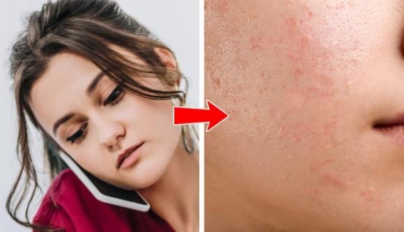 mụn mọc, mọc mụn, tại sao mọc mụn 