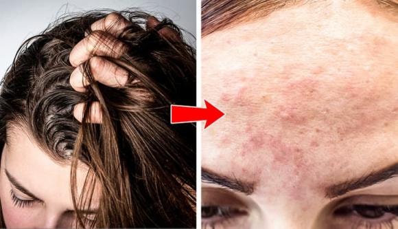 mụn mọc, mọc mụn, tại sao mọc mụn 