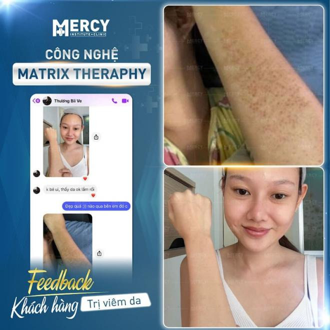 Mercy Matrix Phòng khám Mercy tiết lộ sự thật về công nghệ trị viêm nang lông Matrix ...