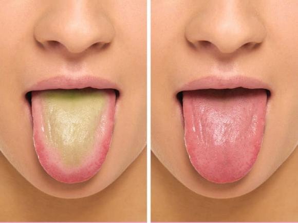 cạo lưỡi, thức dậy, răng miệng