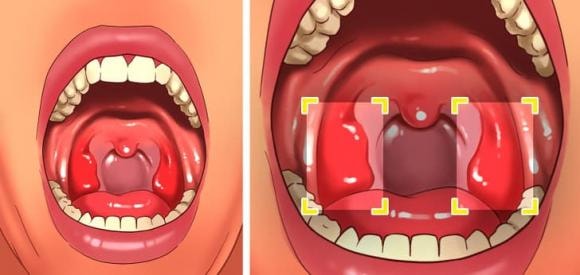 sỏi amidan, viêm họng, tai mũi họng, Sỏi amidan là gì 