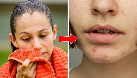 Mụn trứng cá, bộ phận cơ thể, thói quen xấu