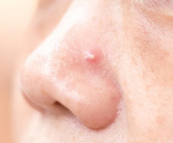Mụn trứng cá, bộ phận cơ thể, thói quen xấu