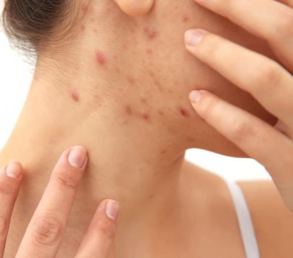 Mụn trứng cá, bộ phận cơ thể, thói quen xấu