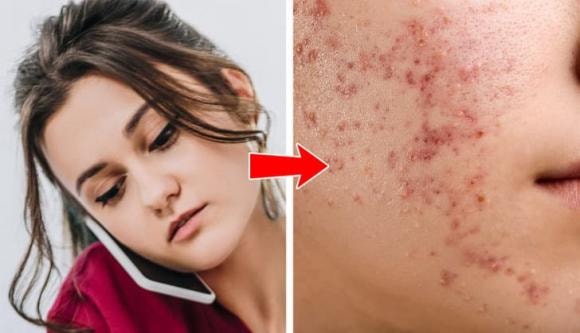 Mụn trứng cá, bộ phận cơ thể, thói quen xấu
