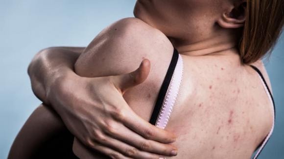 Mụn trứng cá, bộ phận cơ thể, thói quen xấu
