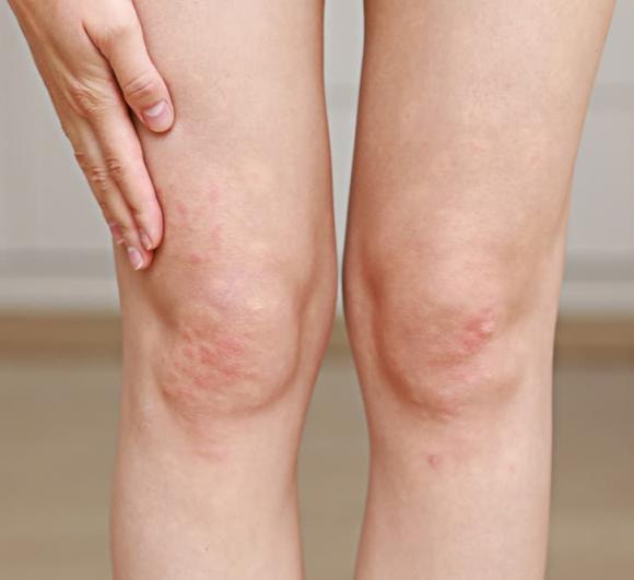 Mụn trứng cá, bộ phận cơ thể, thói quen xấu