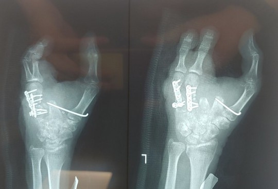 Ghép ngón chân thành ngón tay cho bệnh nhân bị nát tay trái