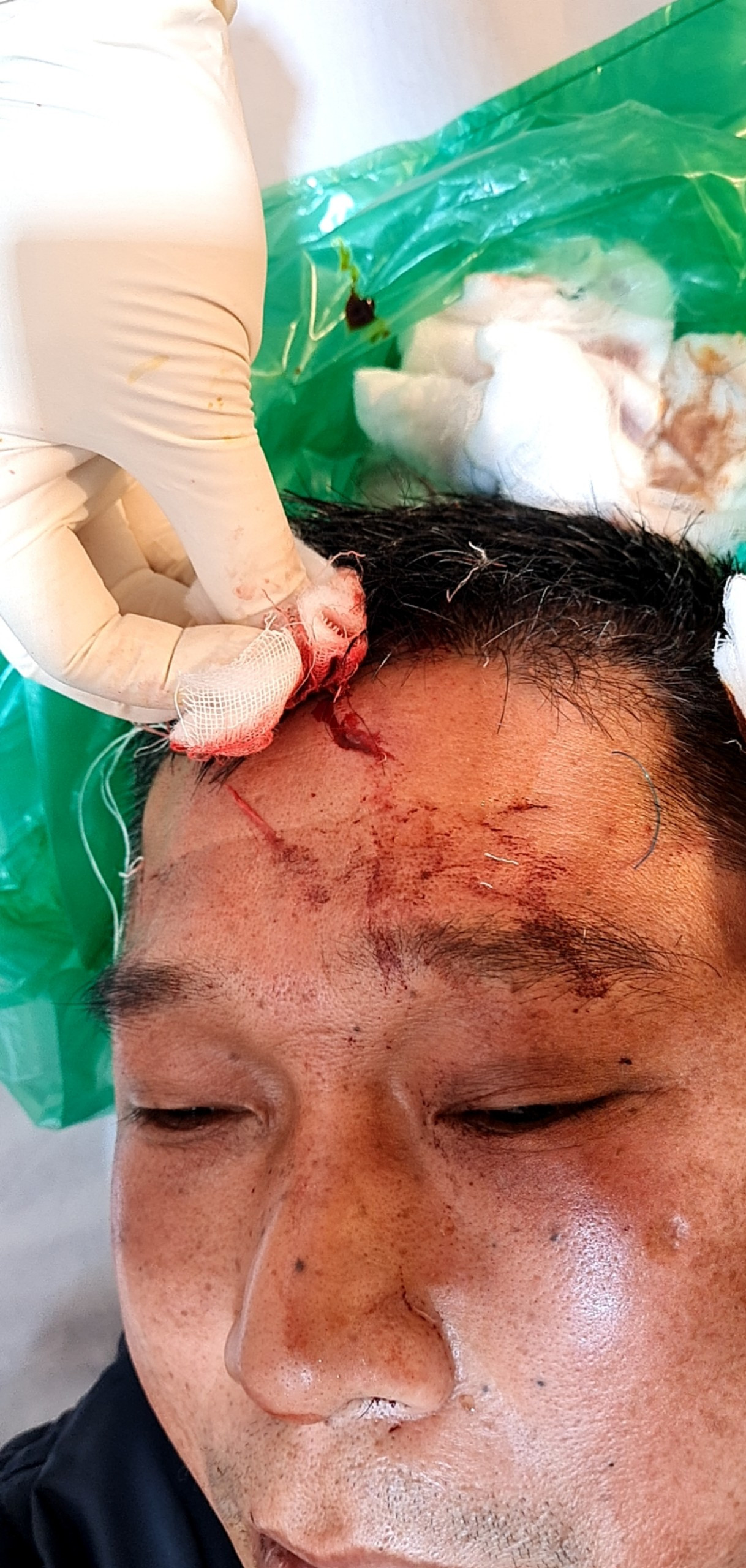 Hà Nội: Một người đàn ông bị đánh rách đầu khi đi lễ đầu năm