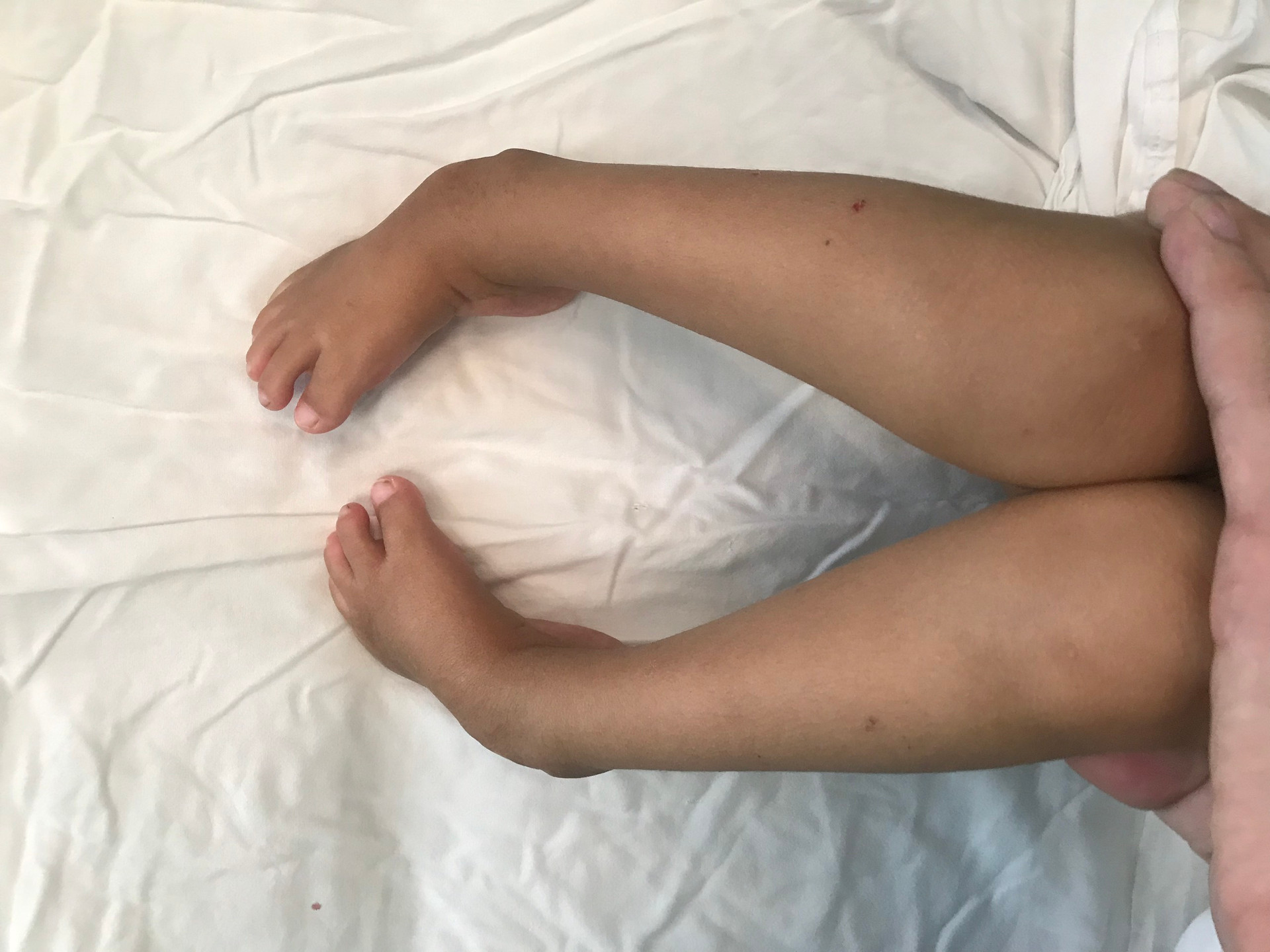 Phẫu thuật thành công cho bé gái 25 tháng tuổi bị dị tật ở chân