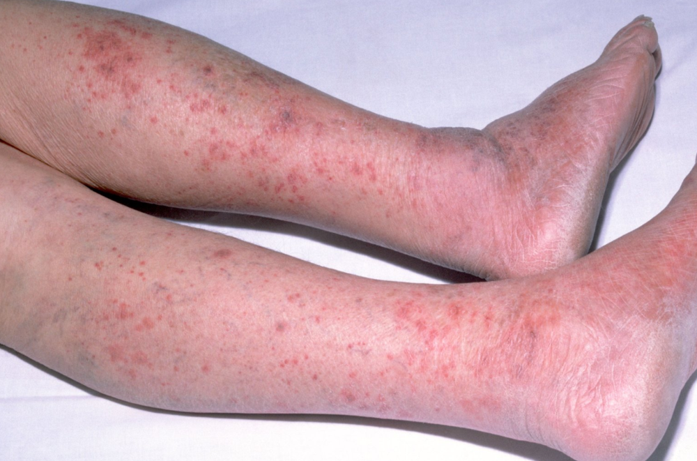 Viêm màng não mô cầu có thể gây tử vong trong 24 giờ