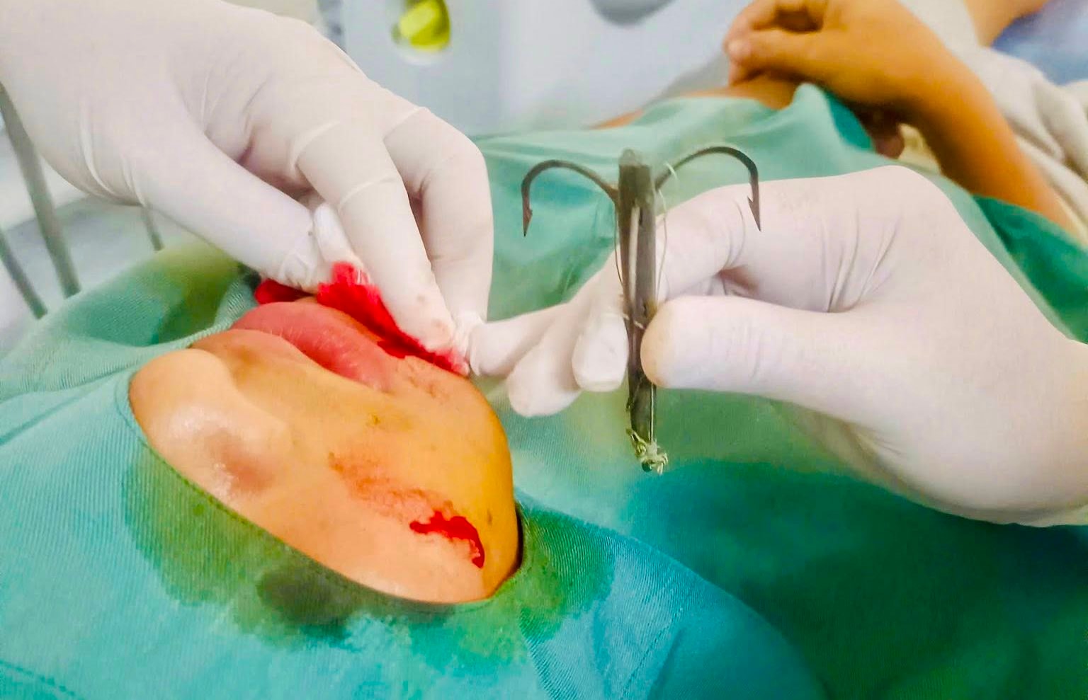 Lưỡi câu móc sâu vào mặt nam sinh 15 tuổi ở Nghệ An