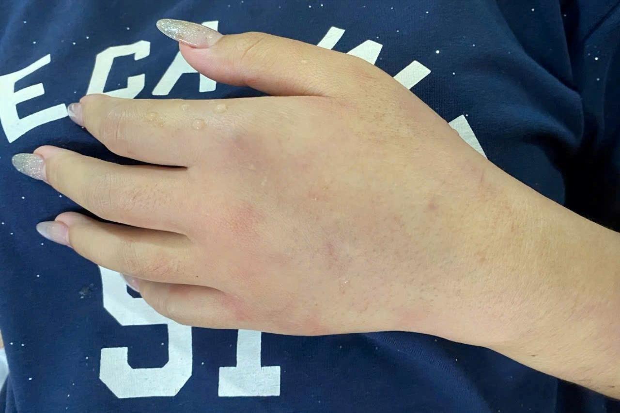 8 người nhập viện vì bị ong rừng đốt khi đi tảo mộ