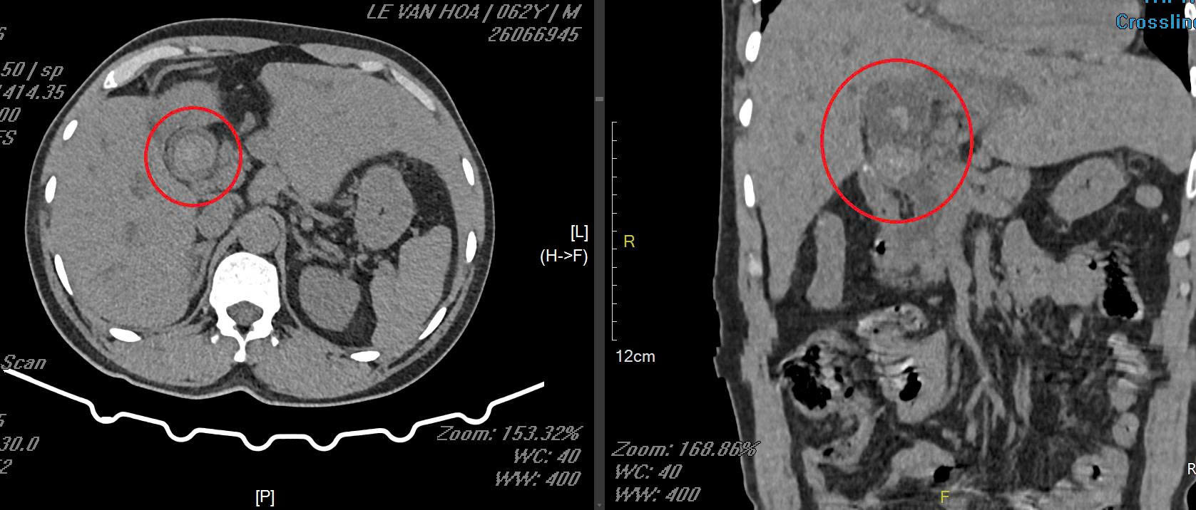 Hình ảnh sỏi đường mật của người bệnh trên CT scan.