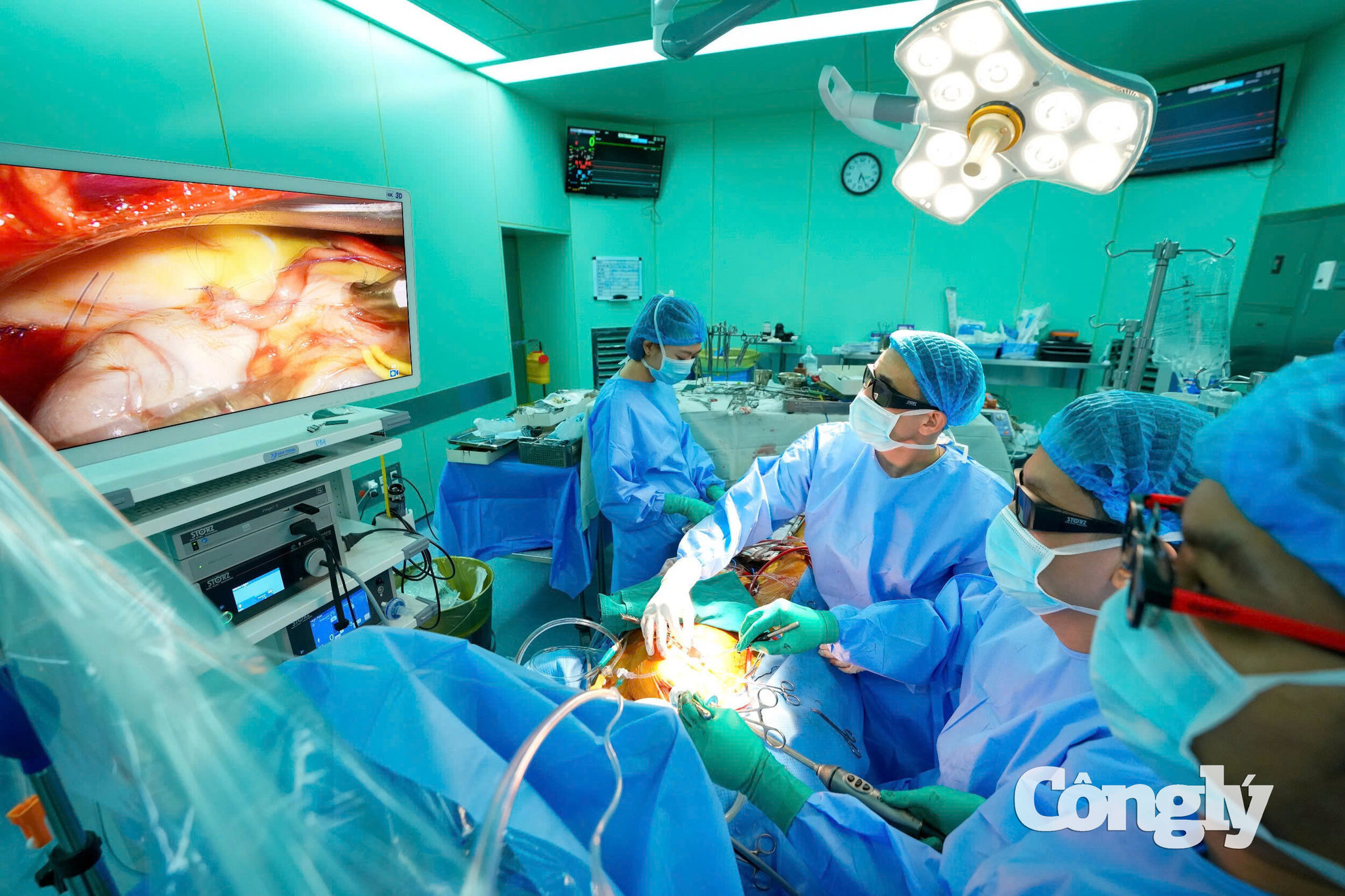 Phẫu thuật viên theo dõi hình ảnh nội soi phóng đại trong quá trình đánh giá và sửa tổn thương van hai lá.