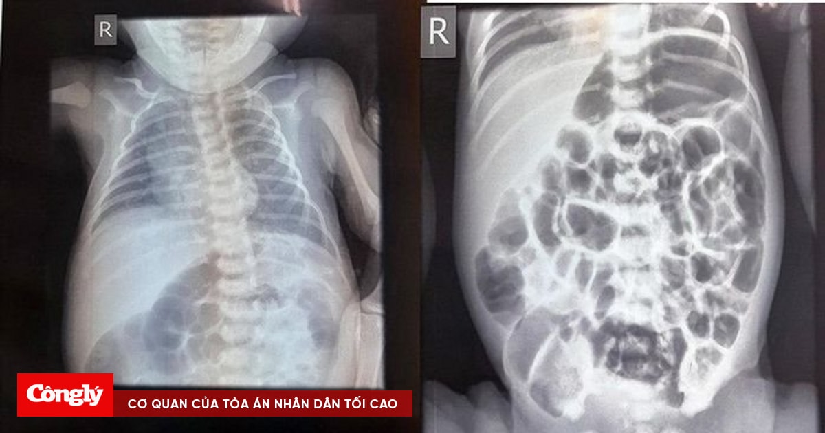 Cứu sống bé sơ sinh mắc Covid-19 nặng kèm viêm ruột hoại tử