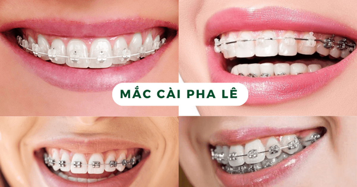 ‏Niềng răng mắc cài pha lê là gì? Ưu nhược điểm của phương pháp này‏
