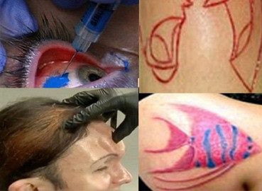 Xăm tròng mắt, lột da... kiểu làm đẹp “rợn tóc gáy” của giới trẻ