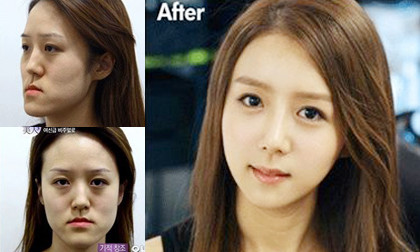 Cô gái xấu xí được phẫu thuật thành 'bản sao YoonA (SNSD)'