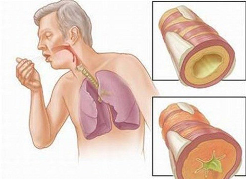 Có thể chuẩn đoán ung thư phổi sớm qua xét nghiệm máu