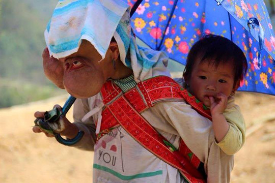 Tận cùng nỗi đau của người phụ nữ 25 năm mang khối u khổng lồ trên mặt