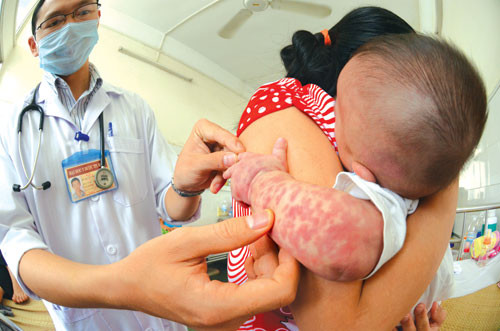 Tăng cường phòng chống dịch sởi trong trường học