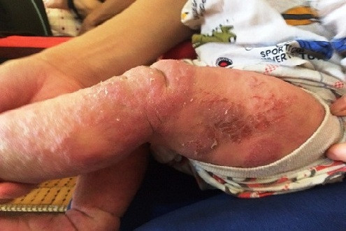Bé 15 tháng tuổi mắc chứng bệnh lạ