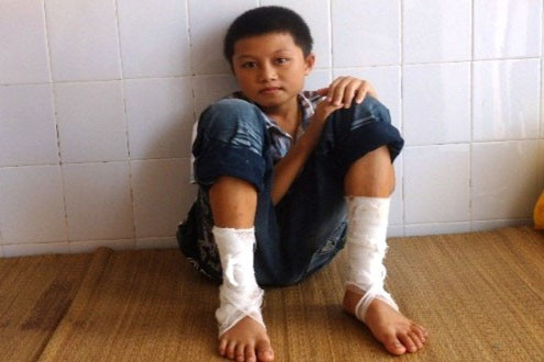 Học sinh bị bỏng nặng do đốt lửa trại sẽ được dạy bù