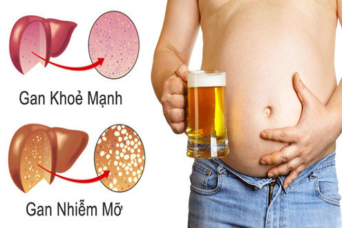 Lời khuyên vàng cho những người gan nhiễm mỡ