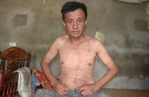 Nỗi đau đeo bám gia đình mắc căn bệnh lạ