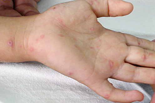 Thời tiết giao mùa, bệnh tay chân miệng có nguy cơ bùng phát trở lại