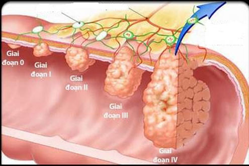 Ung thư đại trực tràng – căn bệnh thường gặp ở nam giới