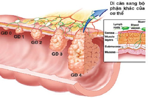 Các giai đoạn phát triển của ung thư dạ dày