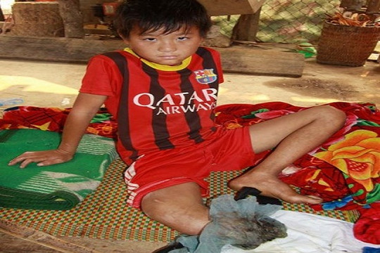 Cậu bé dân tộc Mông “xin cắt chân” đã được phẫu thuật thành công