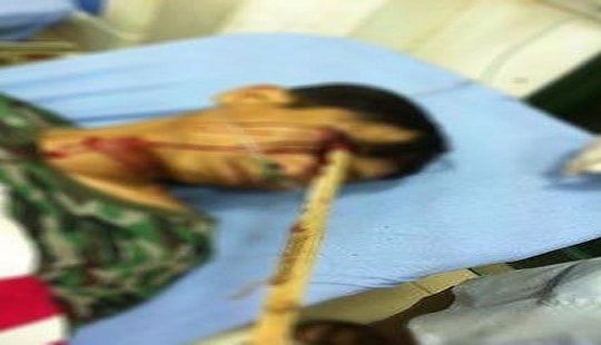 Hy hữu cứu sống nam thanh niên bị cọc đâm xuyên mắt phải