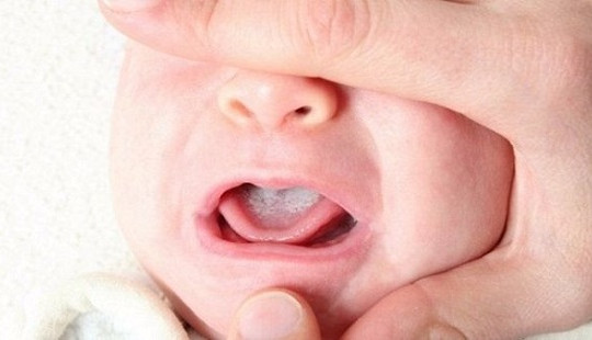 Trẻ có thể bị tử vong khi đánh tưa lưỡi bằng mật ong