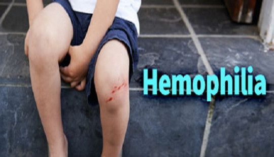 3.600 nam giới Việt có thể chết trước 19 tuổi nếu không được điều trị Hemophilia