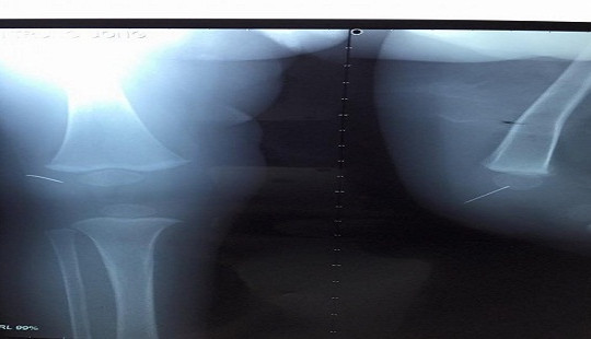 Bé trai 1 tuổi bị kim khâu diều đâm thẳng vào khớp gối