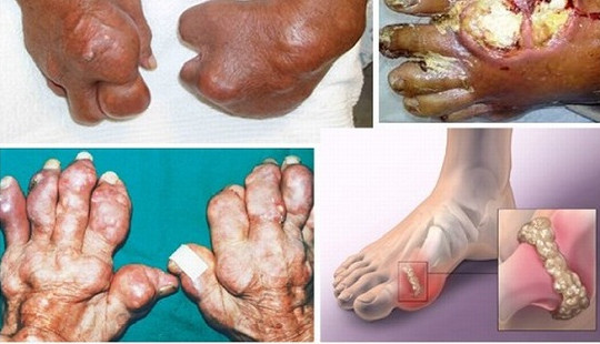 Khi mắc bệnh gút phải làm gì để không bị tàn phế?